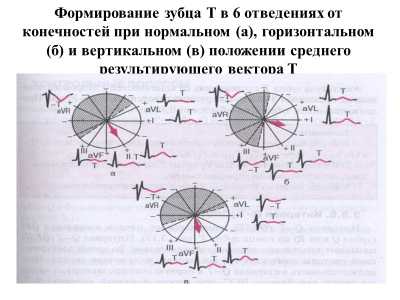 Формирование зубца Т в 6 отведениях от конечностей при нормальном (а), горизонтальном (б) и